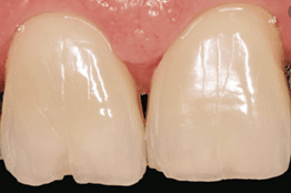 Clenching teeth case 03