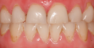 Clenching teeth case 04