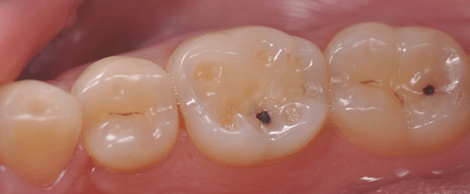 Clenching teeth case 02