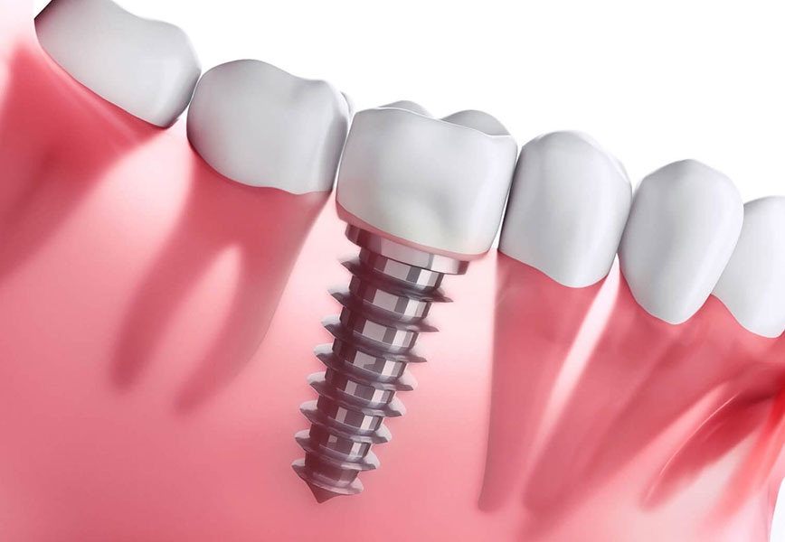 dental implants