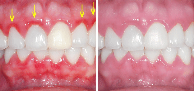 Periodontal gum disease