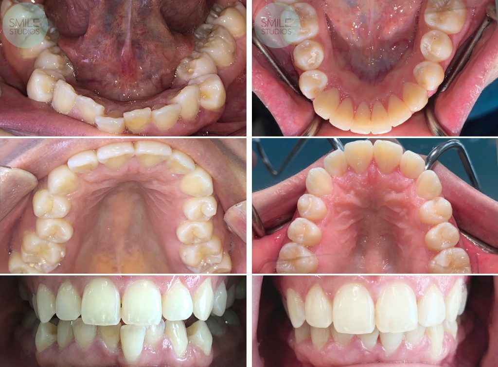 Invisalign Before and After Results