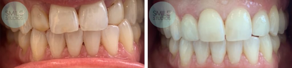 Veneers Before and After Results