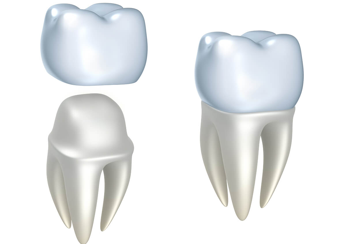 Dental Crown Procedure in Redmond Washington Area