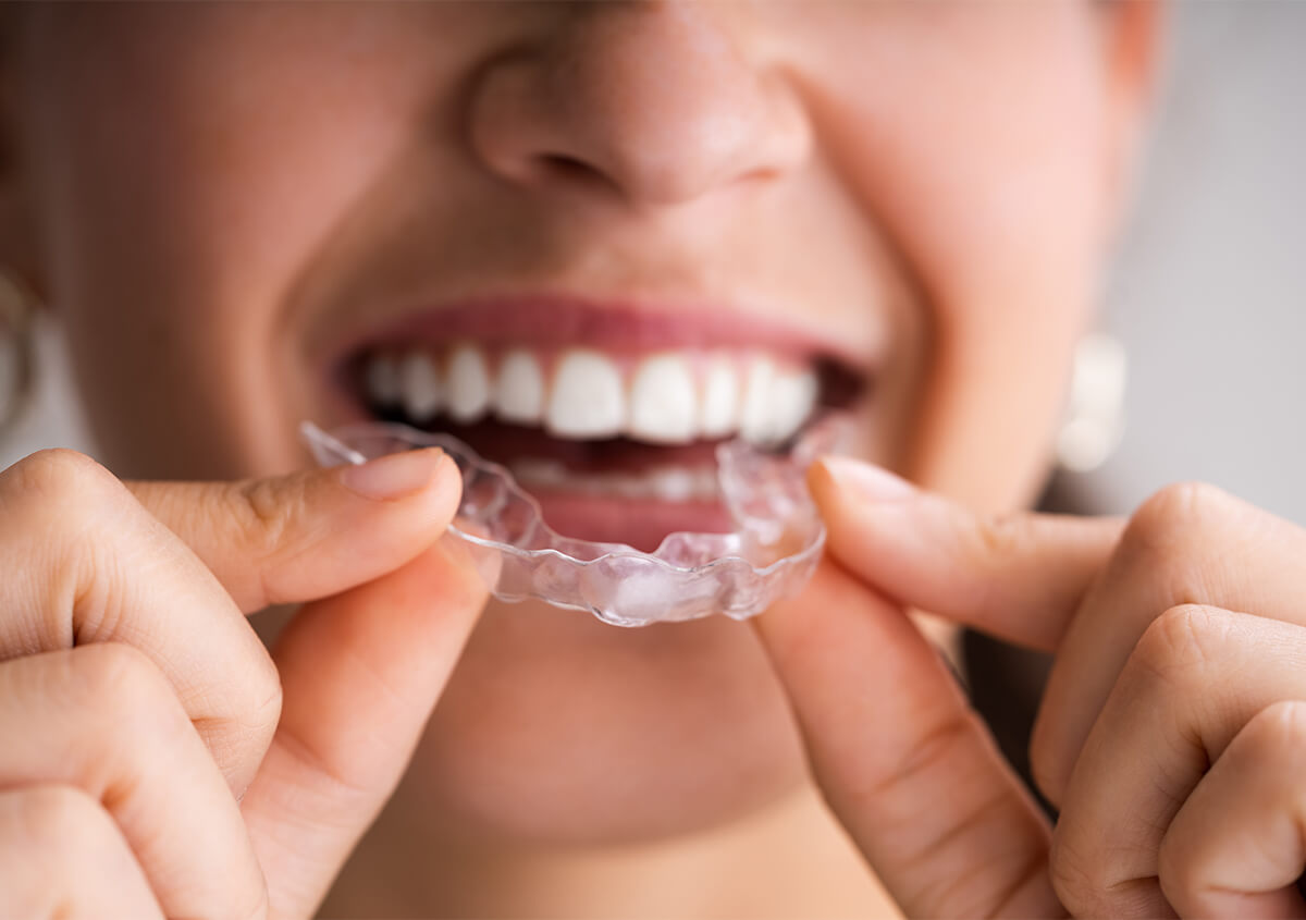Clear Braces for Teeth Straightening in Redmond Area