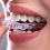 Clear braces for straightening teeth without traditional brackets and wires