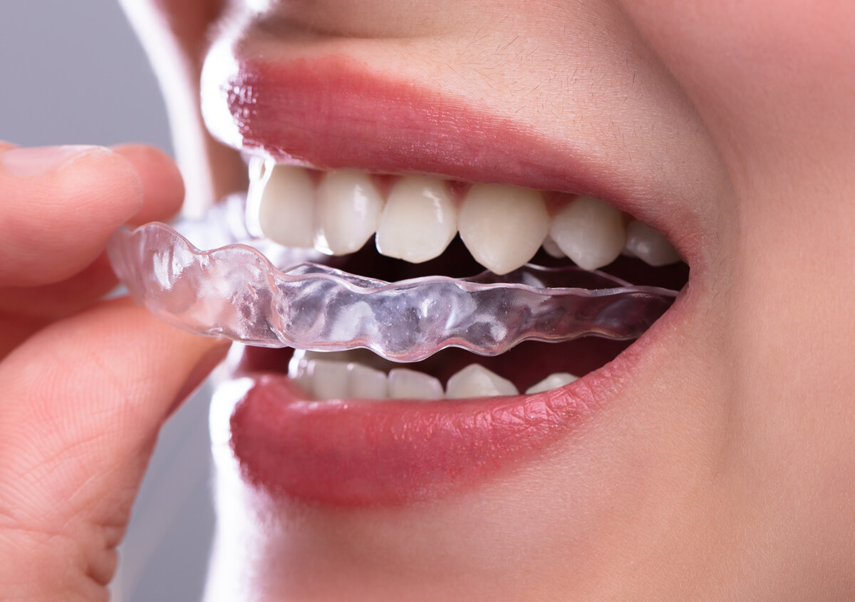 Clear Braces for Teeth Straightening in Redmond WA Area