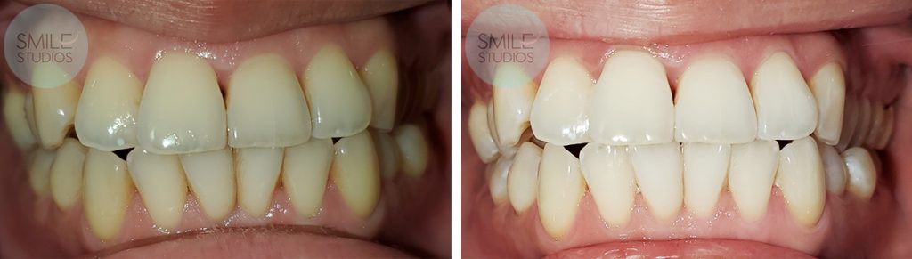 Professional Teeth Whitening before after treatment results near Redmond, WA - Cause 1