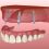 Use implant-supported dentures for a more stable solution