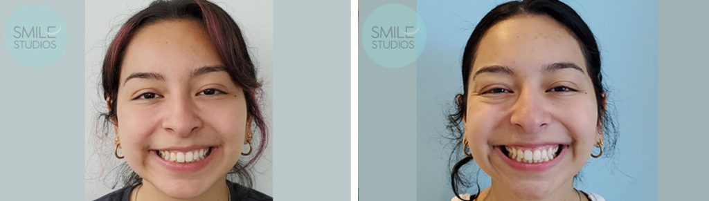 Invisalign Before & After Treatment Results near Redmond, WA - Case 4