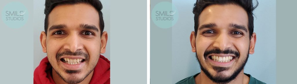 Invisalign Before & After Treatment Results near Redmond, WA - Case 6
