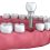 Replacing Your Missing Tooth with Functional and Life-like Single Dental Implants